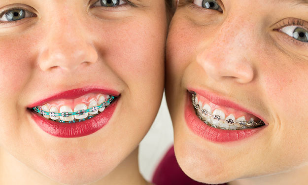 Coloured Braces, Greater Vancouver Orthodontics