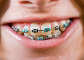 Coloured Braces, Orthodontics, Greater Vancouver Orthodontics