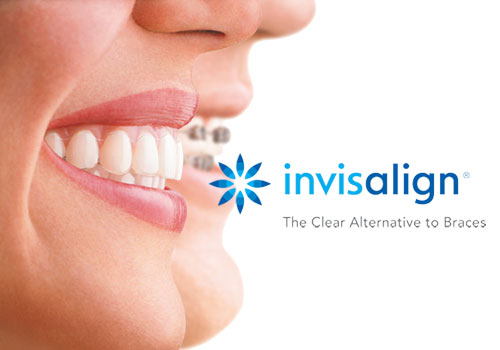 Invisalign for Adults, Greater Vancouver Orthodontics