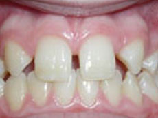 Missing Teeth, Greater Vancouver Orthodontics, BC