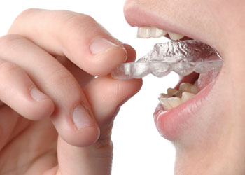 Invisalign Clear Braces, Greater Vancouver Orthodontics