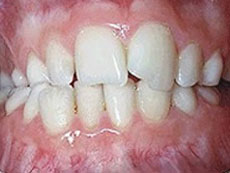 Cross Bite, Greater Vancouver Orthodontics, BC