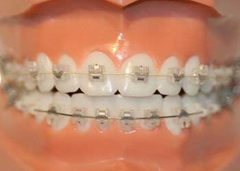 In-Ovation Mini-Metallic Braces, Greater Vancouver Orthodontics
