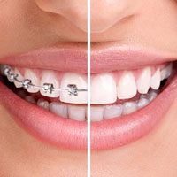 Translucent Cosmetic Braces  Greater Vancouver Orthodontics