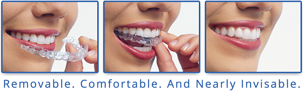 Invisalign Clear Braces, Greater Vancouver Orthodontics