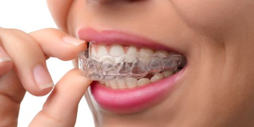 Invisalign in Vancouver