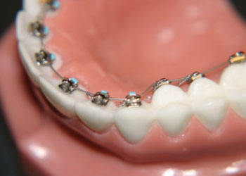 Translucent Cosmetic Braces, Greater Vancouver Orthodontics, BC