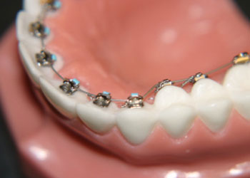 Types of Braces - McMillian Orthodontics