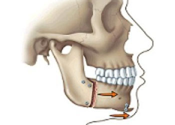 Surgical Orthodontics, Greater Vancouver Orthodontics BC