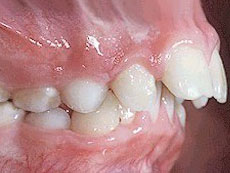 Protruded Teeth, myORTHODONTIST Vancouver, BC