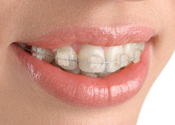 Translucent Cosmetic Braces, Greater Vancouver Orthodontics, BC