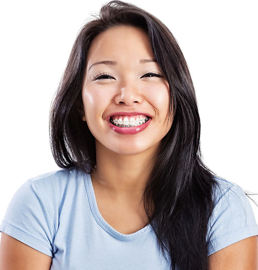 Translucent Cosmetic Braces, Greater Vancouver Orthodontics