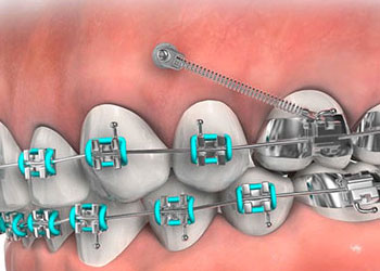 Temporary Anchorage Device, Greater Vancouver Orthodontics